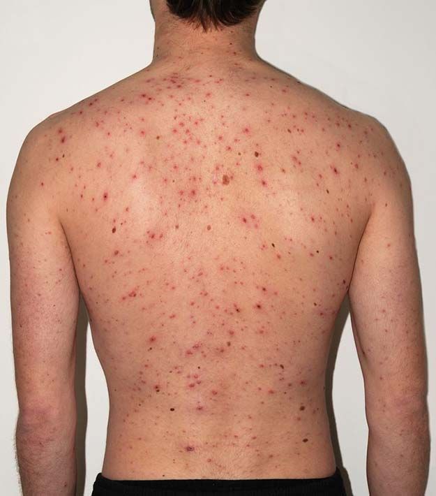 acne