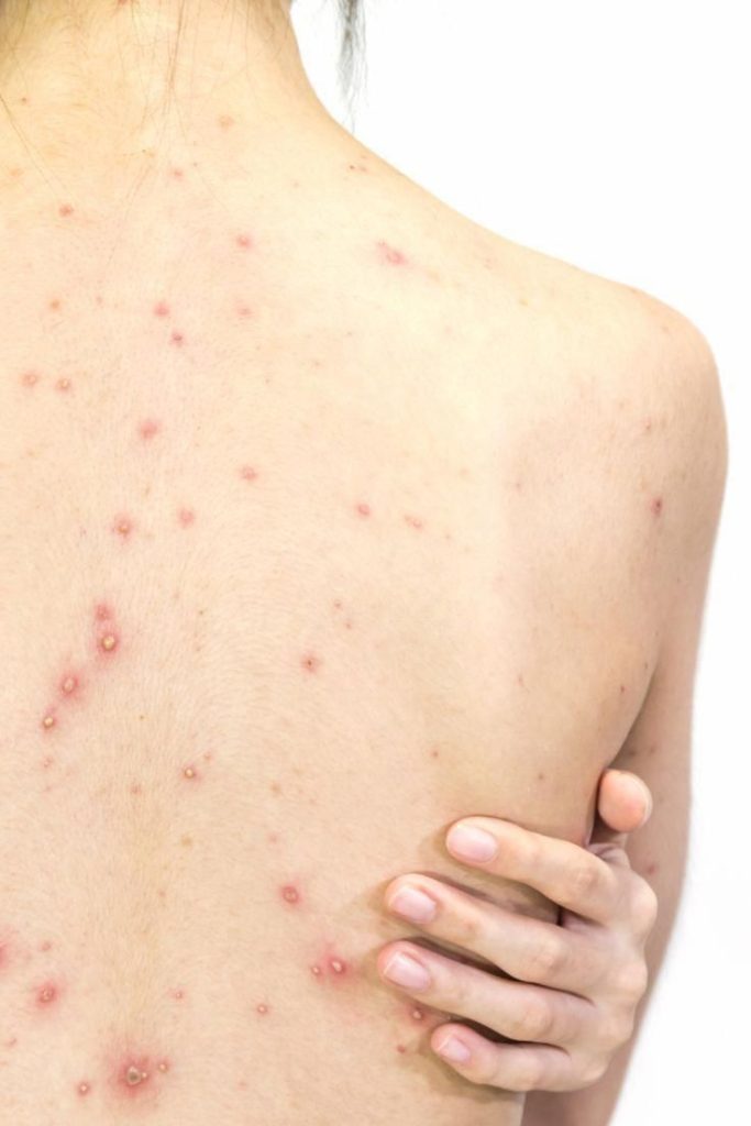acne