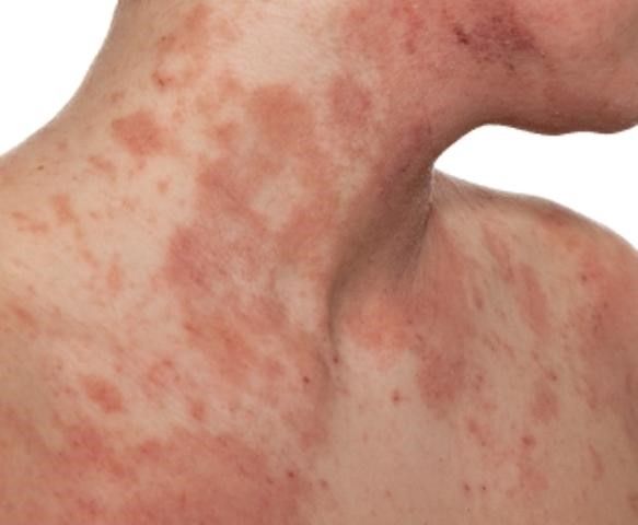allergy