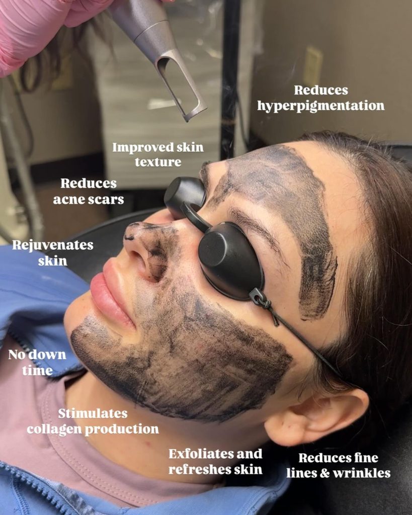 carbon peel