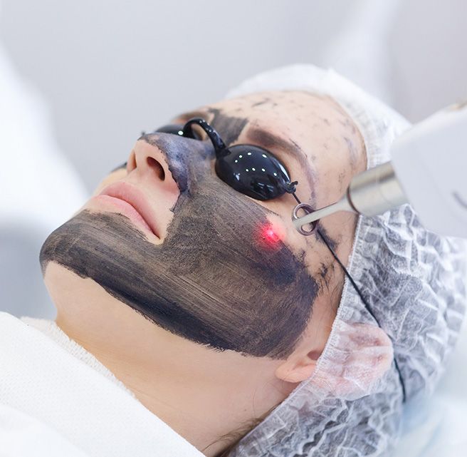 carbon peel