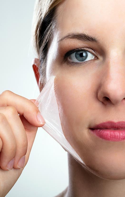chemical peel