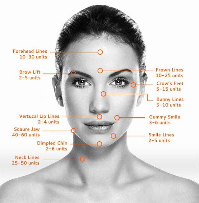 dermal filers
