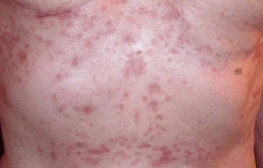 eczema