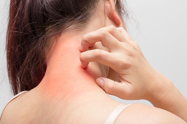 eczema