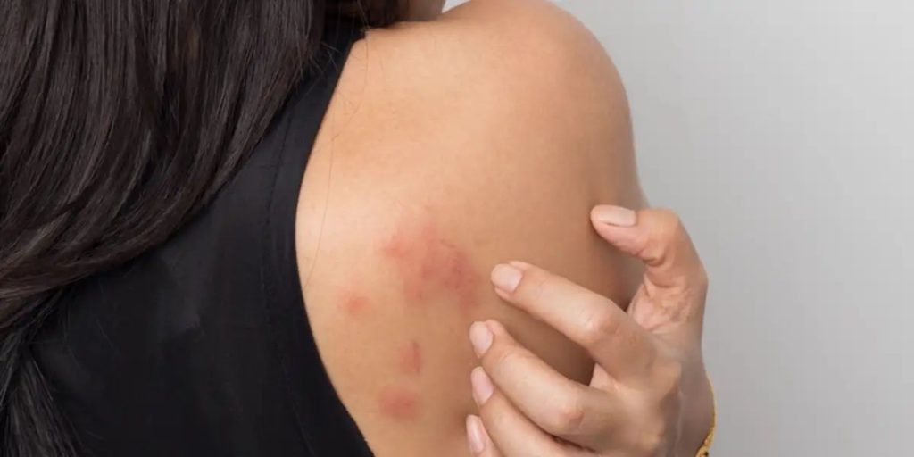 hives