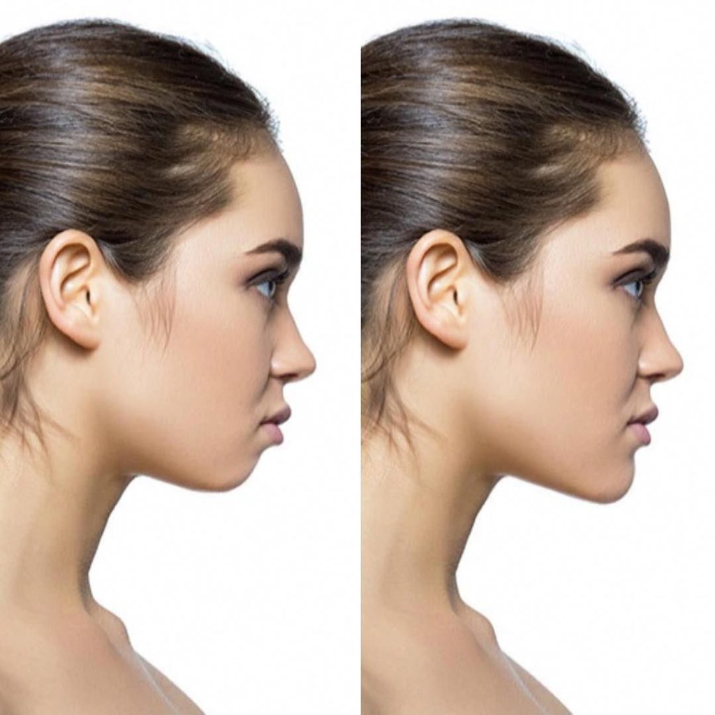 kybella