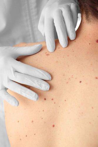 skin cancer