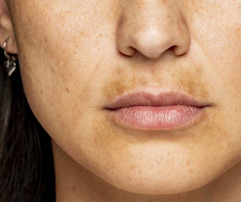 Pigmentation & Melasma Correction