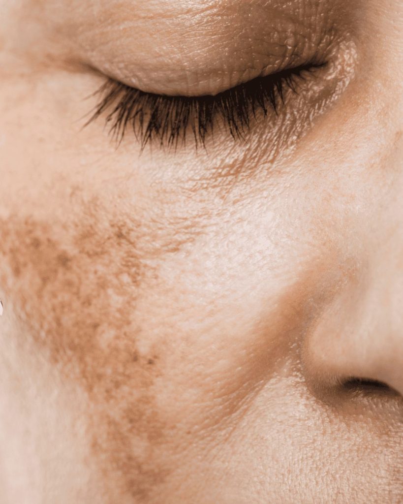 Pigmentation & Melasma Correction