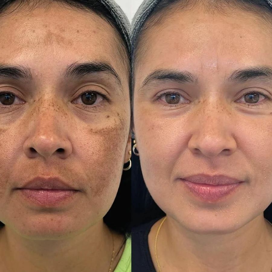 Pigmentation & Melasma Correction